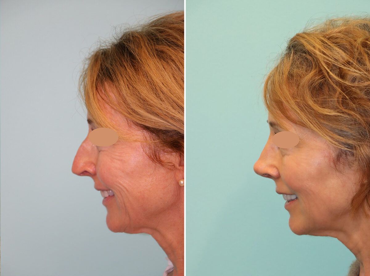 Before and after Rhinoplasty by Dr. Shervin Naderi, Patient 44774