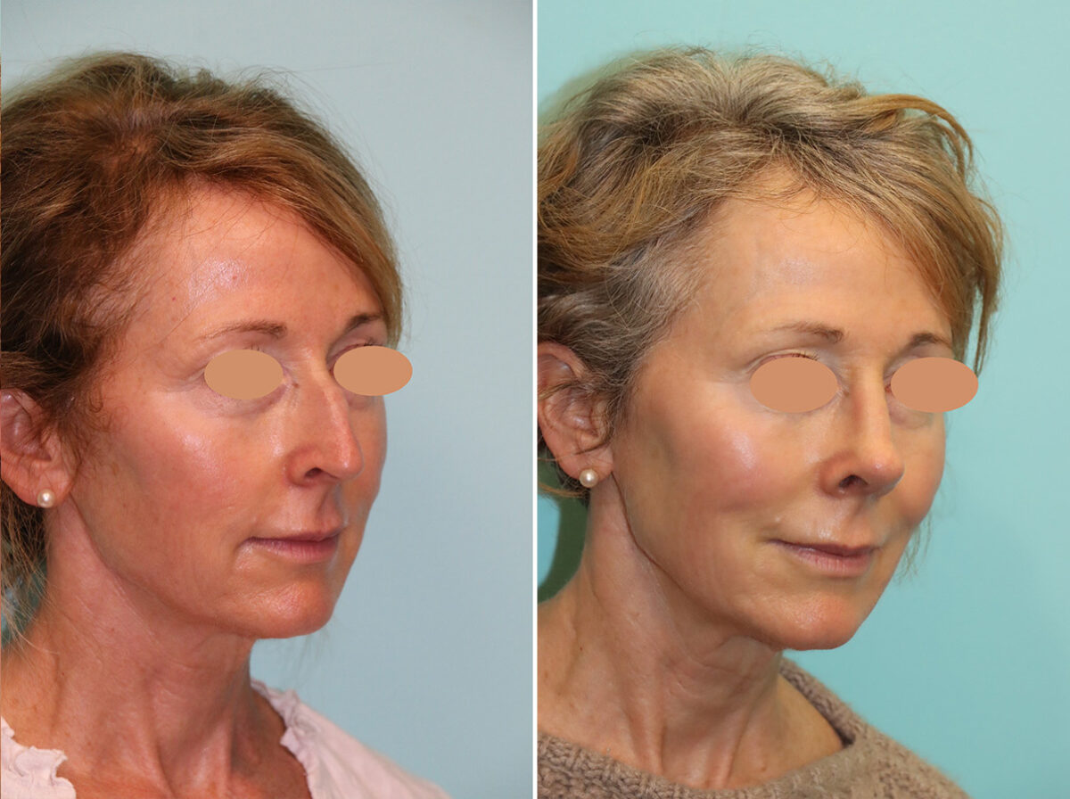 Before and after Rhinoplasty by Dr. Shervin Naderi, Patient 44774
