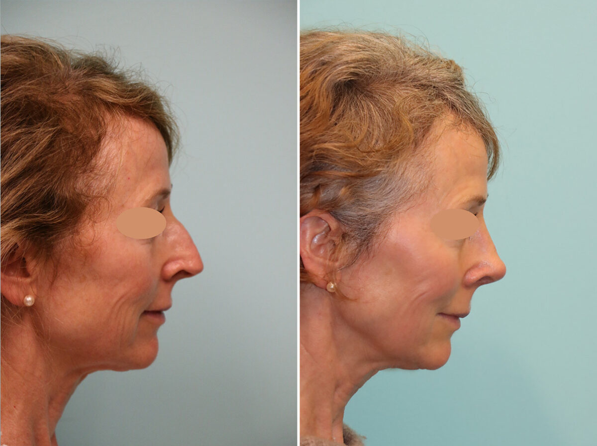 Before and after Rhinoplasty by Dr. Shervin Naderi, Patient 44774