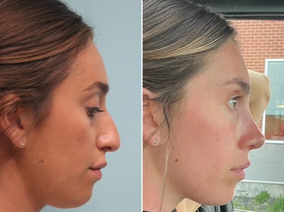 Before and after Rhinoplasty by Dr. Shervin Naderi, Patient 44796