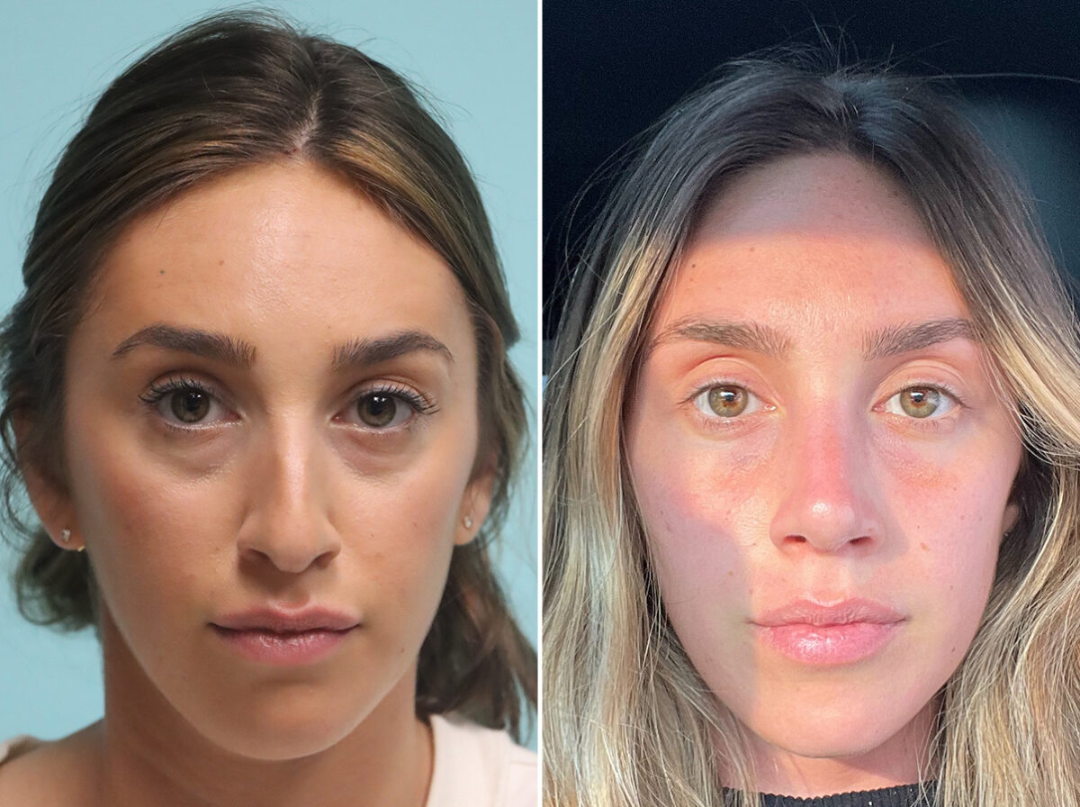 Patient 44796, Rhinoplasty Before and After Photos Before and after Rhinoplasty by Dr. Shervin Naderi, Patient 44796
