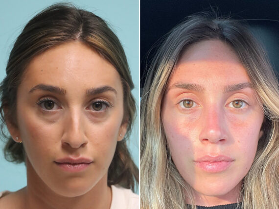 Before and after Rhinoplasty by Dr. Shervin Naderi, Patient 44796