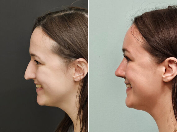 Before and after Rhinoplasty by Dr. Shervin Naderi, Patient 45268