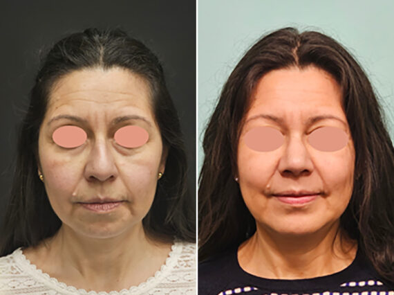 Before and after Chin & Facial Implant by Dr. Shervin Naderi, Patient 45280