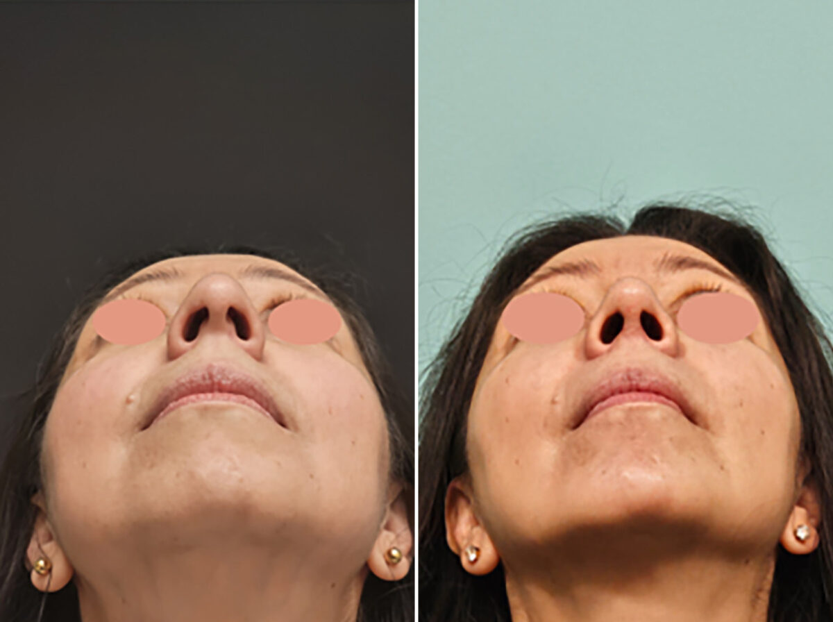Patient 45295, Rhinoplasty Before and After Photos Before and after Rhinoplasty by Dr. Shervin Naderi, Patient 45295
