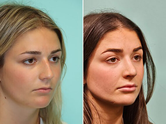 Before and after Rhinoplasty by Dr. Shervin Naderi, Patient 46164