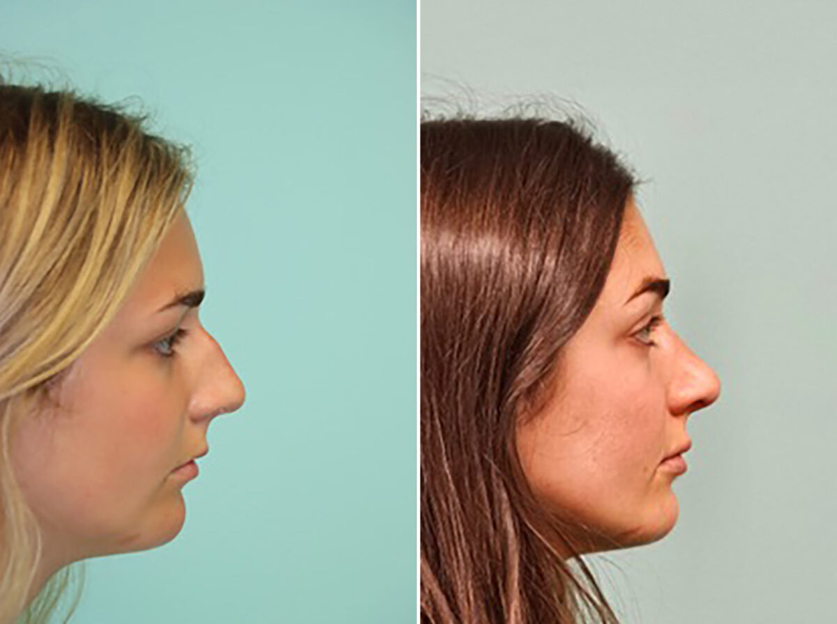 Before and after Rhinoplasty by Dr. Shervin Naderi, Patient 46164