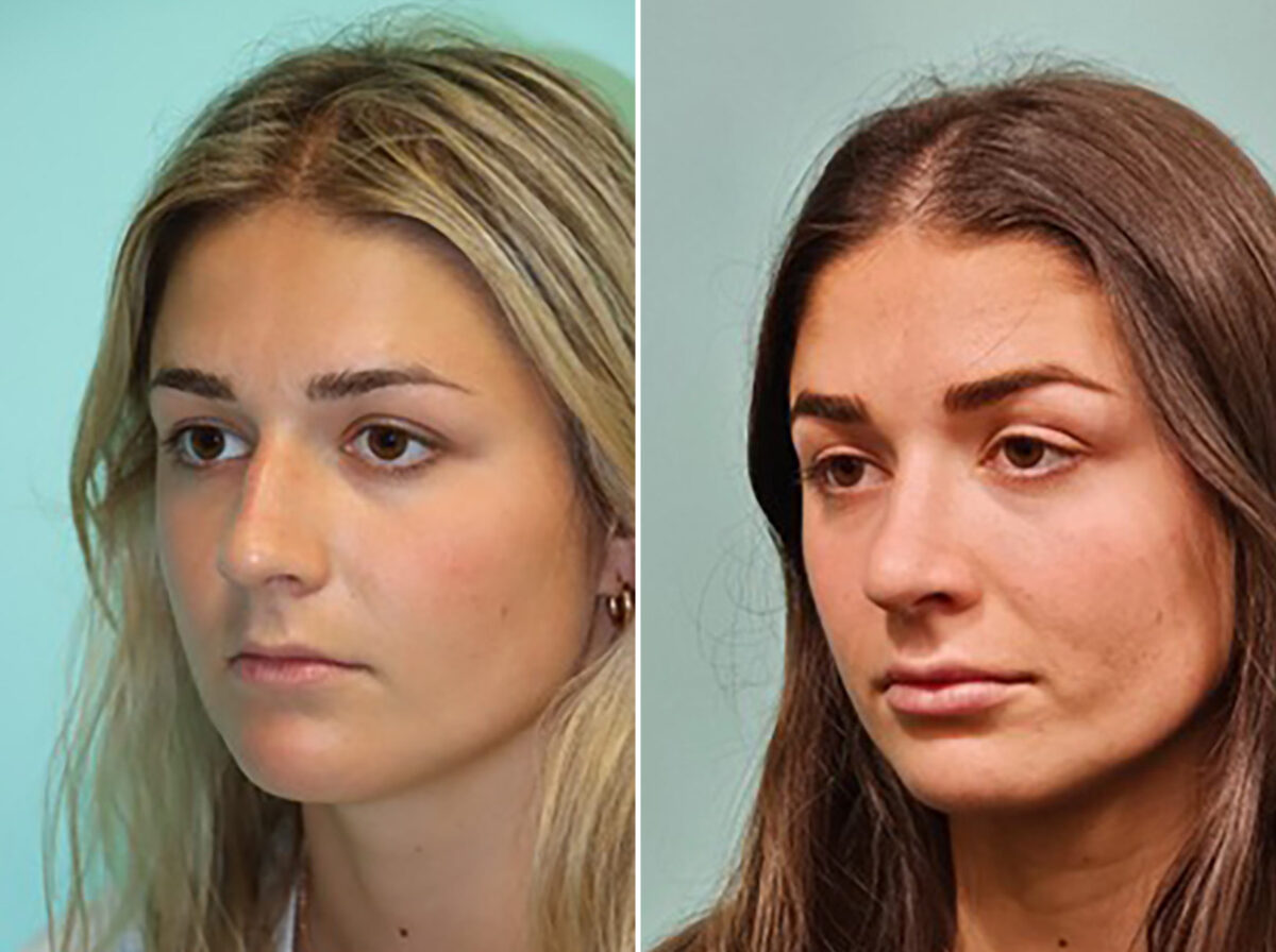 Before and after Rhinoplasty by Dr. Shervin Naderi, Patient 46164