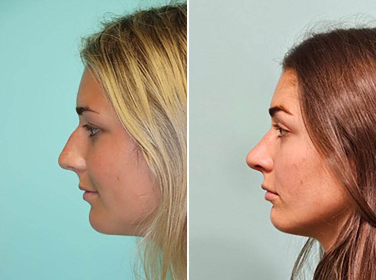 Before and after Rhinoplasty by Dr. Shervin Naderi, Patient 46164