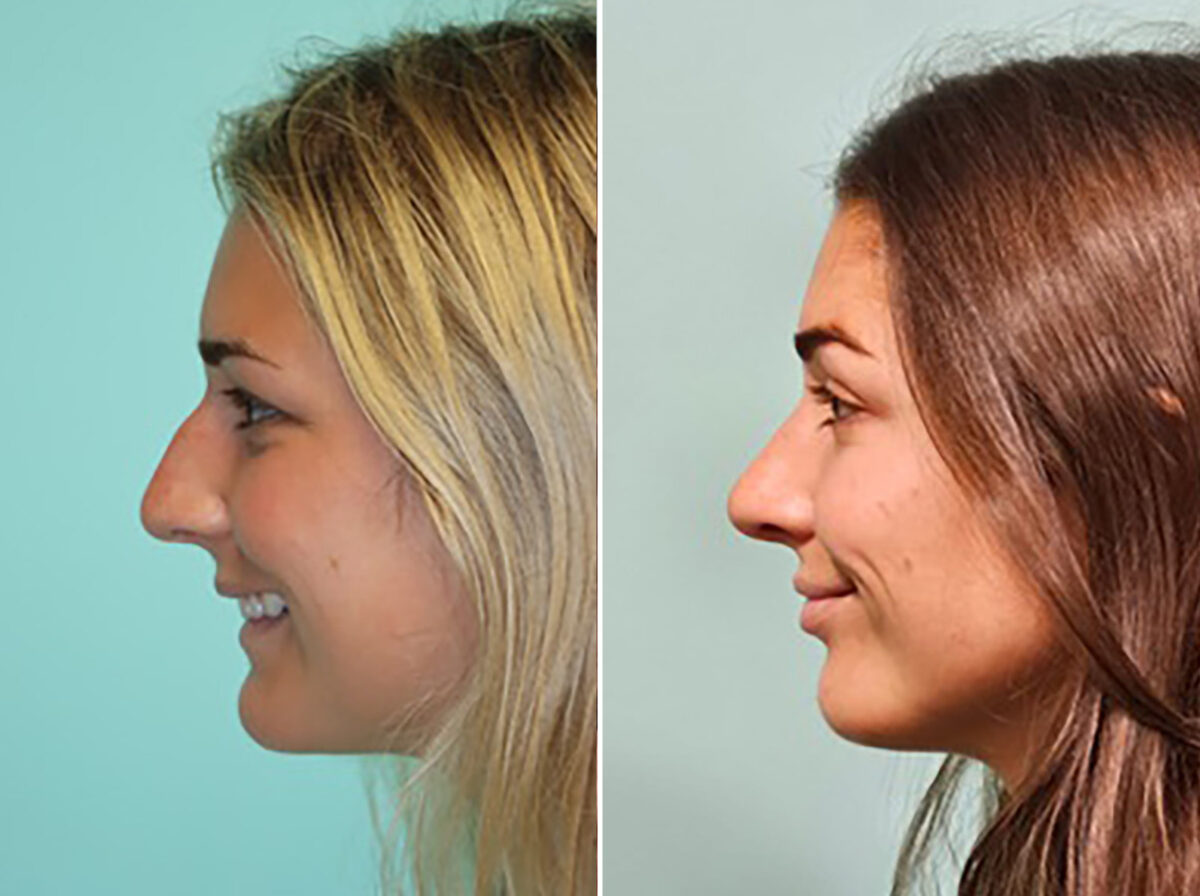 Before and after Rhinoplasty by Dr. Shervin Naderi, Patient 46164