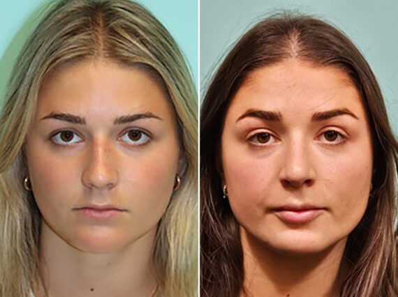 Before and after Rhinoplasty by Dr. Shervin Naderi, Patient 46164