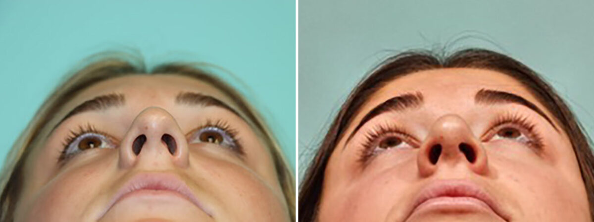 Before and after Rhinoplasty by Dr. Shervin Naderi, Patient 46164