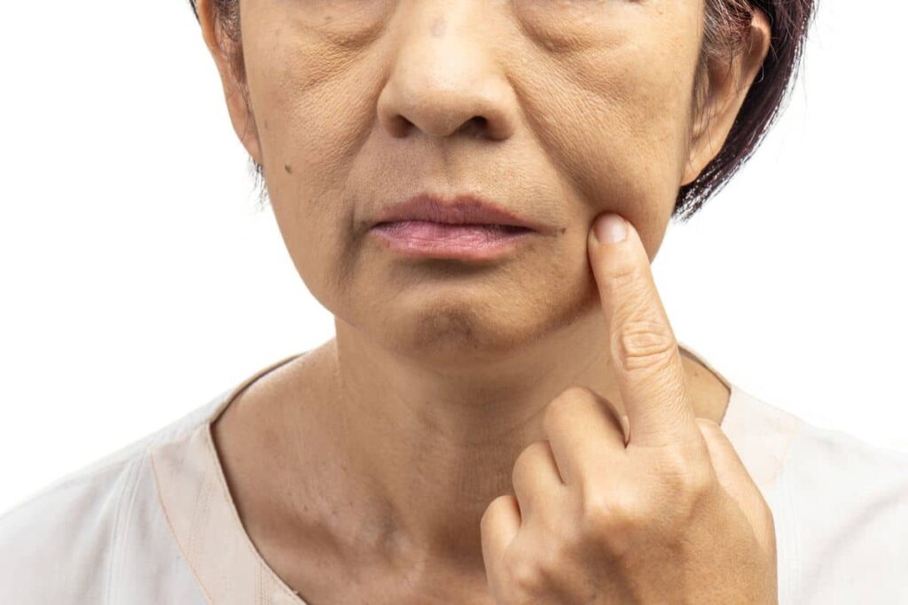 Close-up of middle-aged woman pointing to sagging cheek, highlighting facial volume loss from weight reduction.