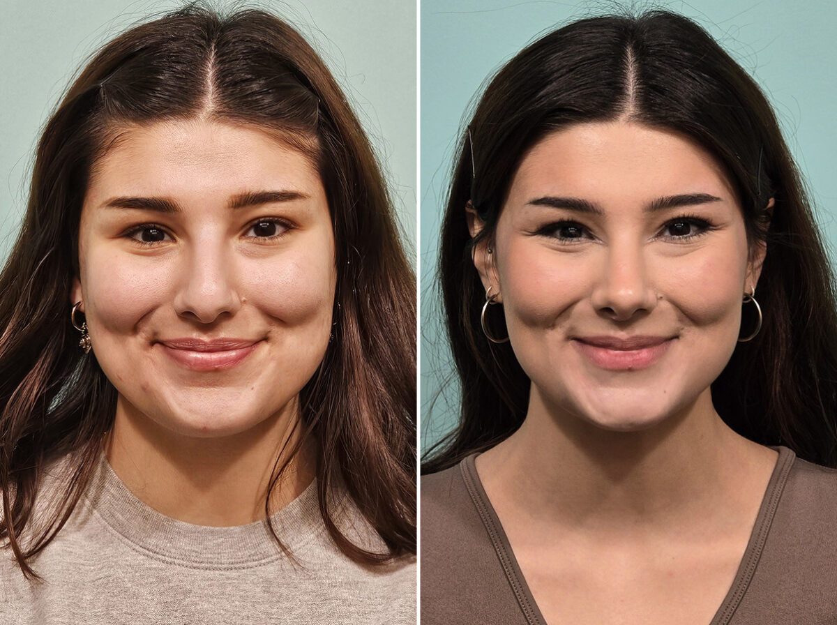 Before and after Rhinoplasty by Dr. Shervin Naderi, Patient 46583