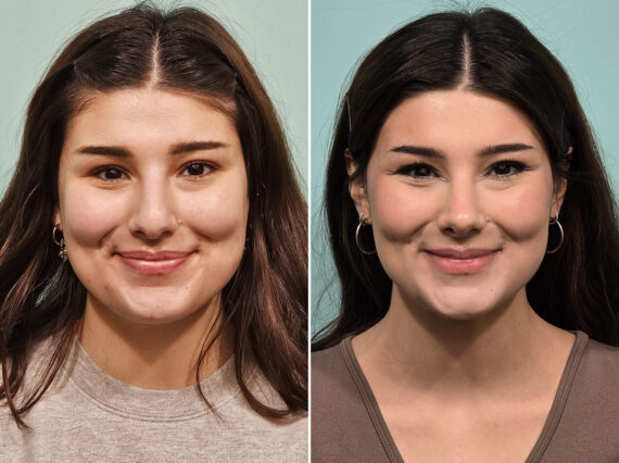 Before and after Rhinoplasty by Dr. Shervin Naderi, Patient 46583