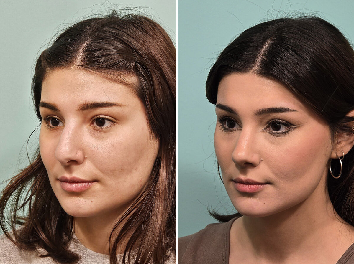 Before and after Rhinoplasty by Dr. Shervin Naderi, Patient 46583