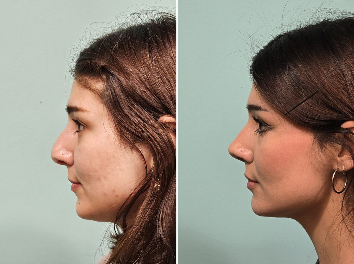 Before and after Rhinoplasty by Dr. Shervin Naderi, Patient 46583