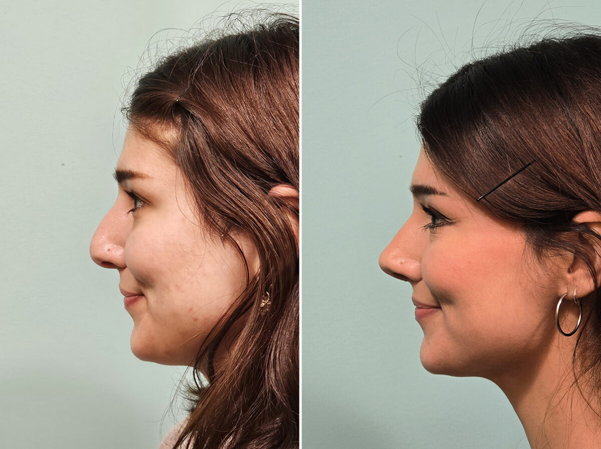Before and after Rhinoplasty by Dr. Shervin Naderi, Patient 46583