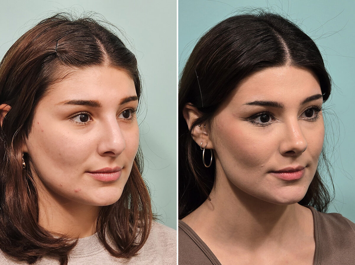 Before and after Rhinoplasty by Dr. Shervin Naderi, Patient 46583