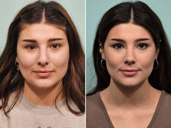 Before and after Rhinoplasty by Dr. Shervin Naderi, Patient 46583