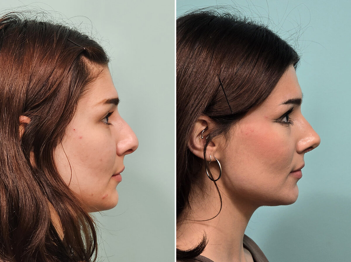 Before and after Rhinoplasty by Dr. Shervin Naderi, Patient 46583