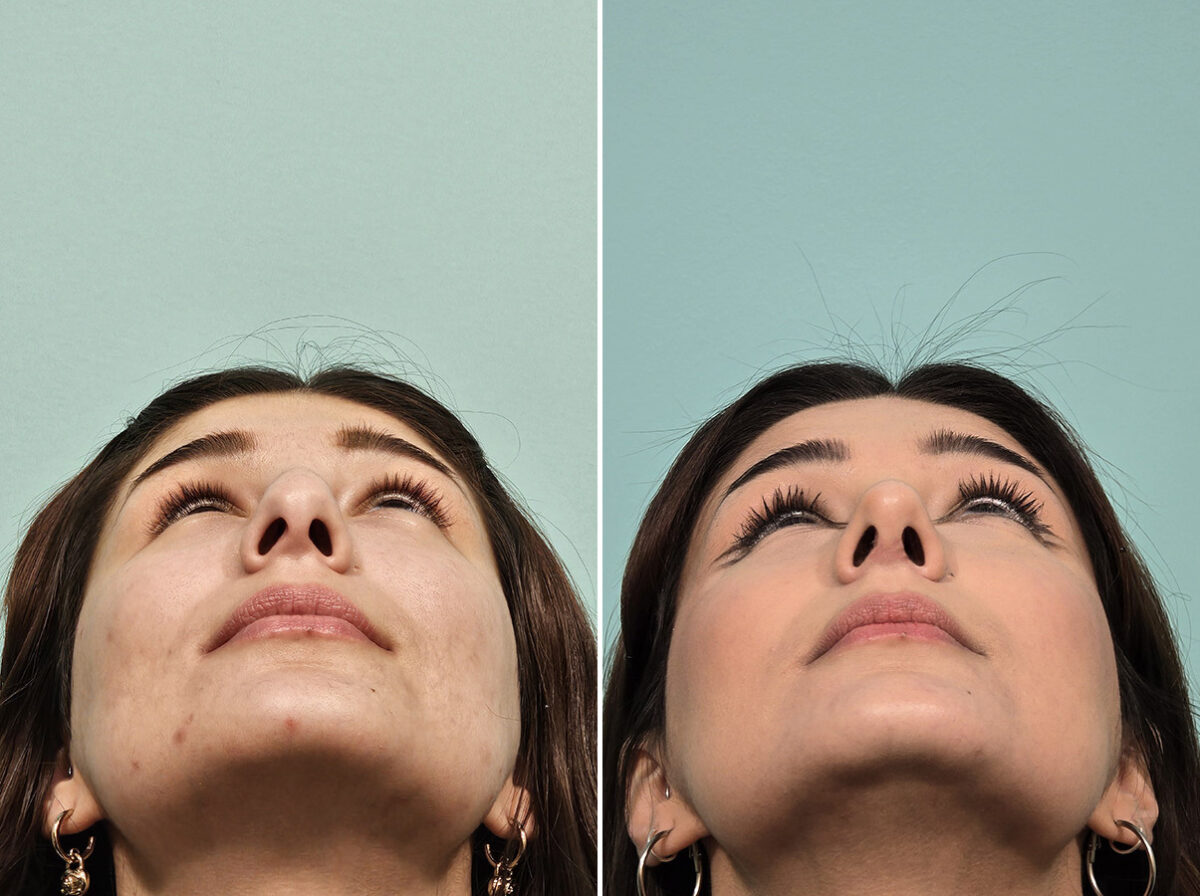 Before and after Rhinoplasty by Dr. Shervin Naderi, Patient 46583