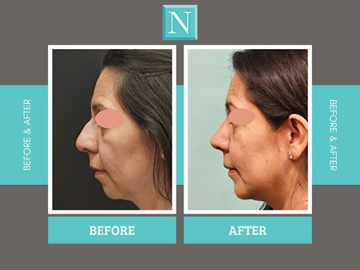A recessed chin can affect overall facial balance and this patient ...