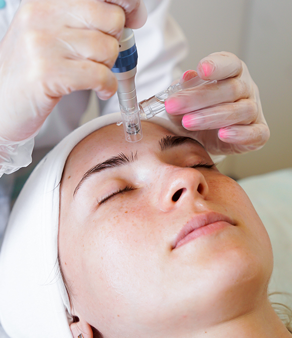 Microneedling procedure at The Naderi Center to rejuvenate skin by boosting collagen and reducing fine lines