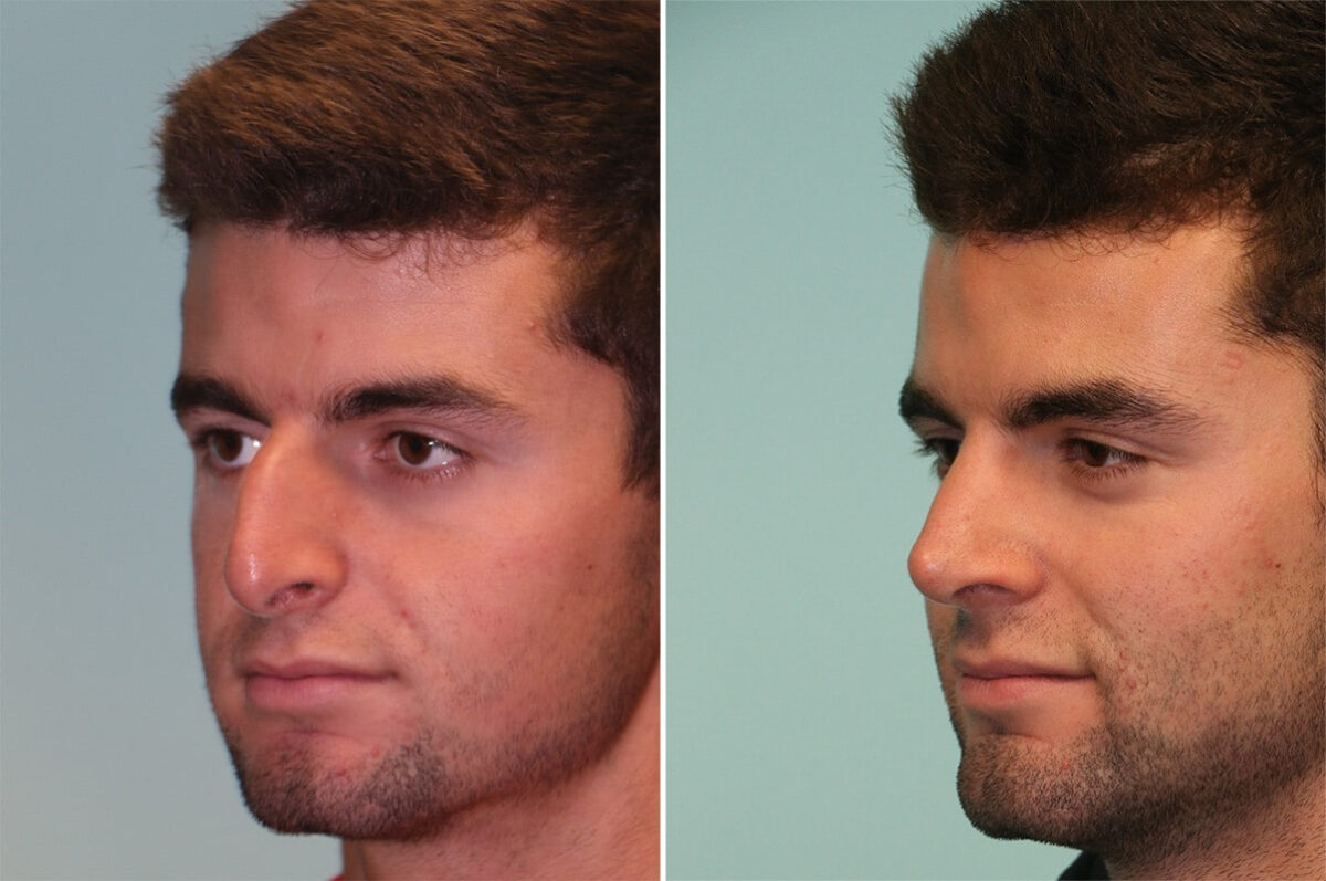 Before and after Rhinoplasty by Dr. Shervin Naderi, Patient 12061
