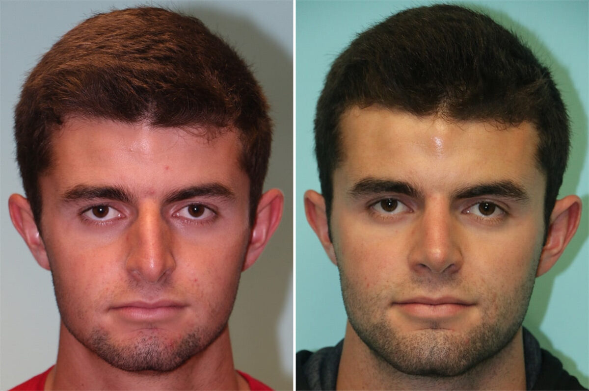 Before and after Rhinoplasty by Dr. Shervin Naderi, Patient 12061