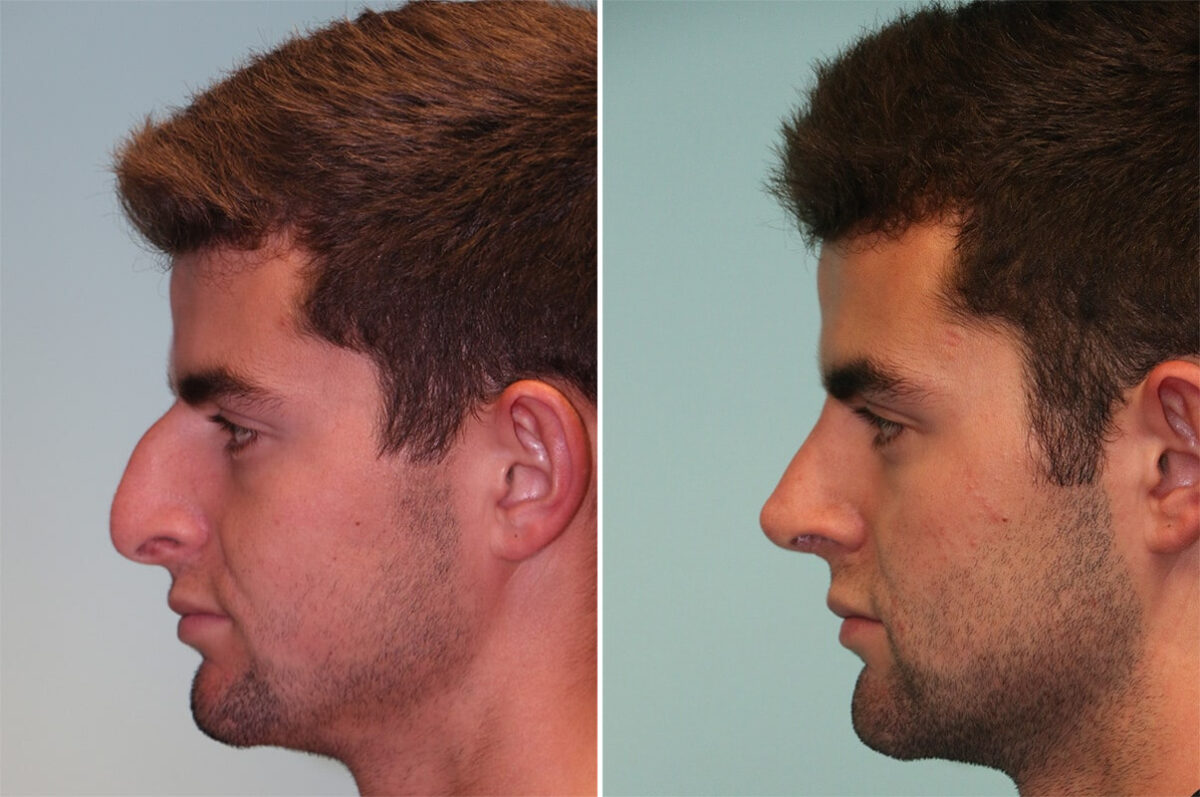 Before and after Rhinoplasty by Dr. Shervin Naderi, Patient 12061