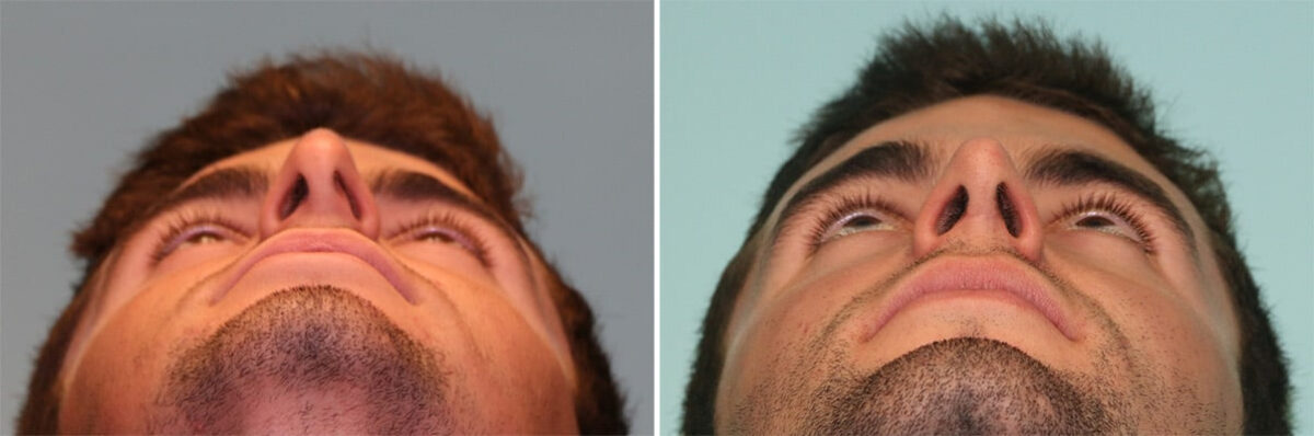 Before and after Rhinoplasty by Dr. Shervin Naderi, Patient 12061