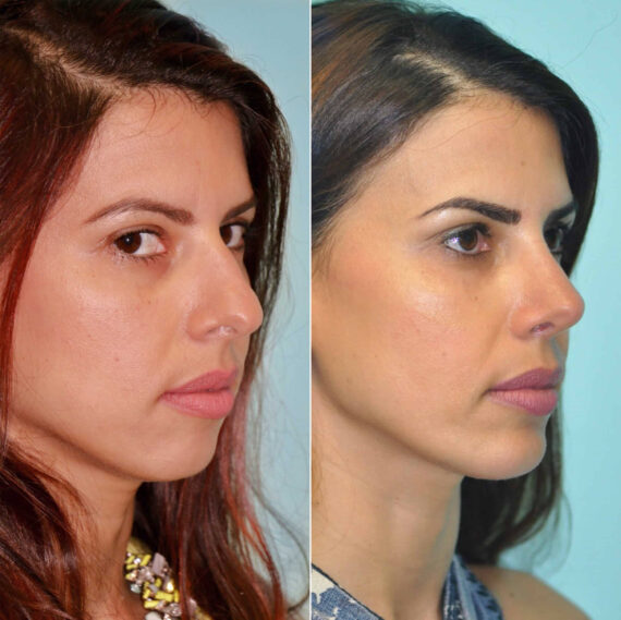 Before and after Chin & Facial Implant by Dr. Shervin Naderi, Patient 12273