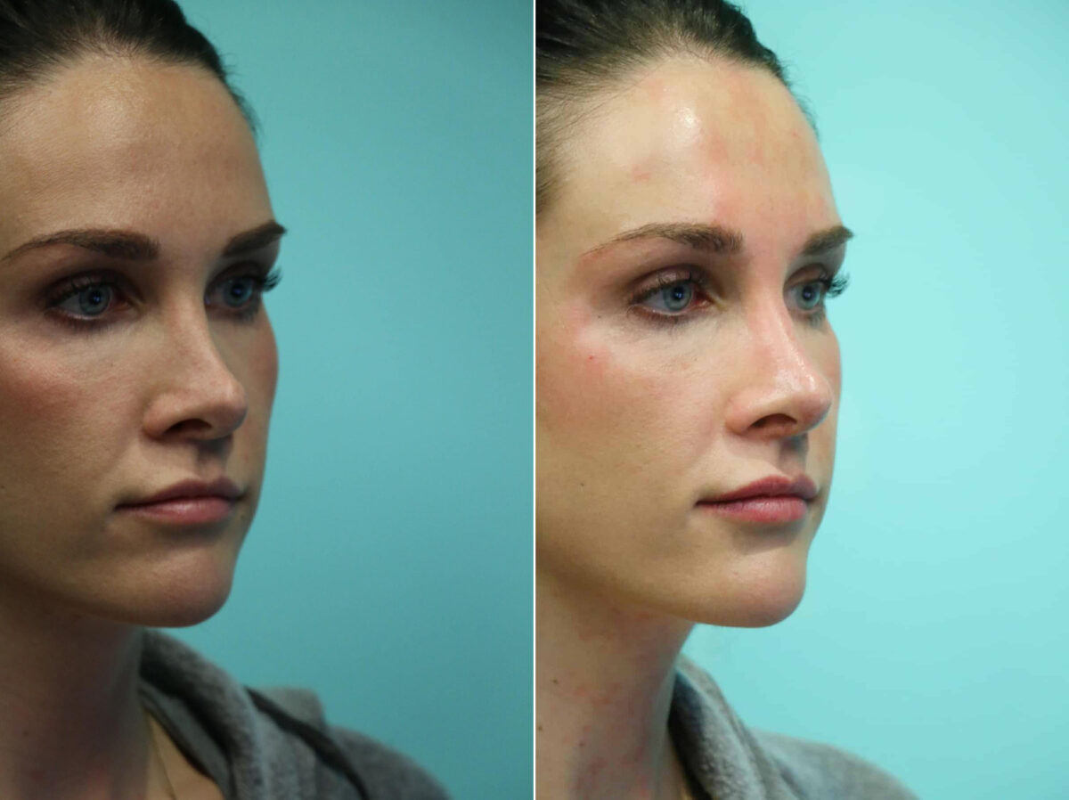 Before and after Non-Surgical Rhinoplasty by Dr. Shervin Naderi, Patient 12357