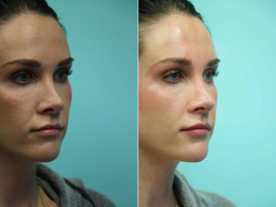 Before and after Non-Surgical Rhinoplasty by Dr. Shervin Naderi, Patient 12357