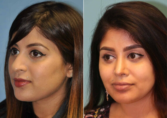 Before and after Rhinoplasty by Dr. Shervin Naderi, Patient 12521