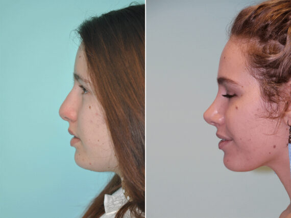 Before and after Rhinoplasty by Dr. Shervin Naderi, Patient 12958