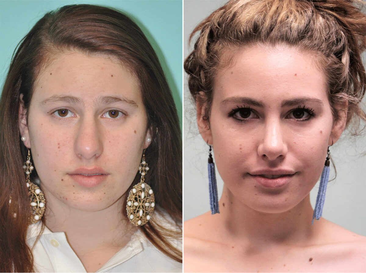 Before and after Rhinoplasty by Dr. Shervin Naderi, Patient 12958