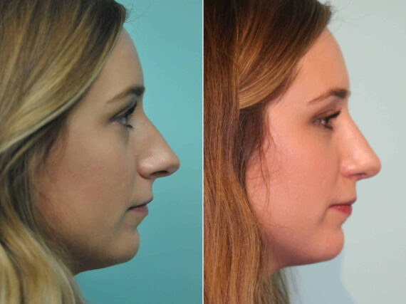Before and after Rhinoplasty by Dr. Shervin Naderi, Patient 12985