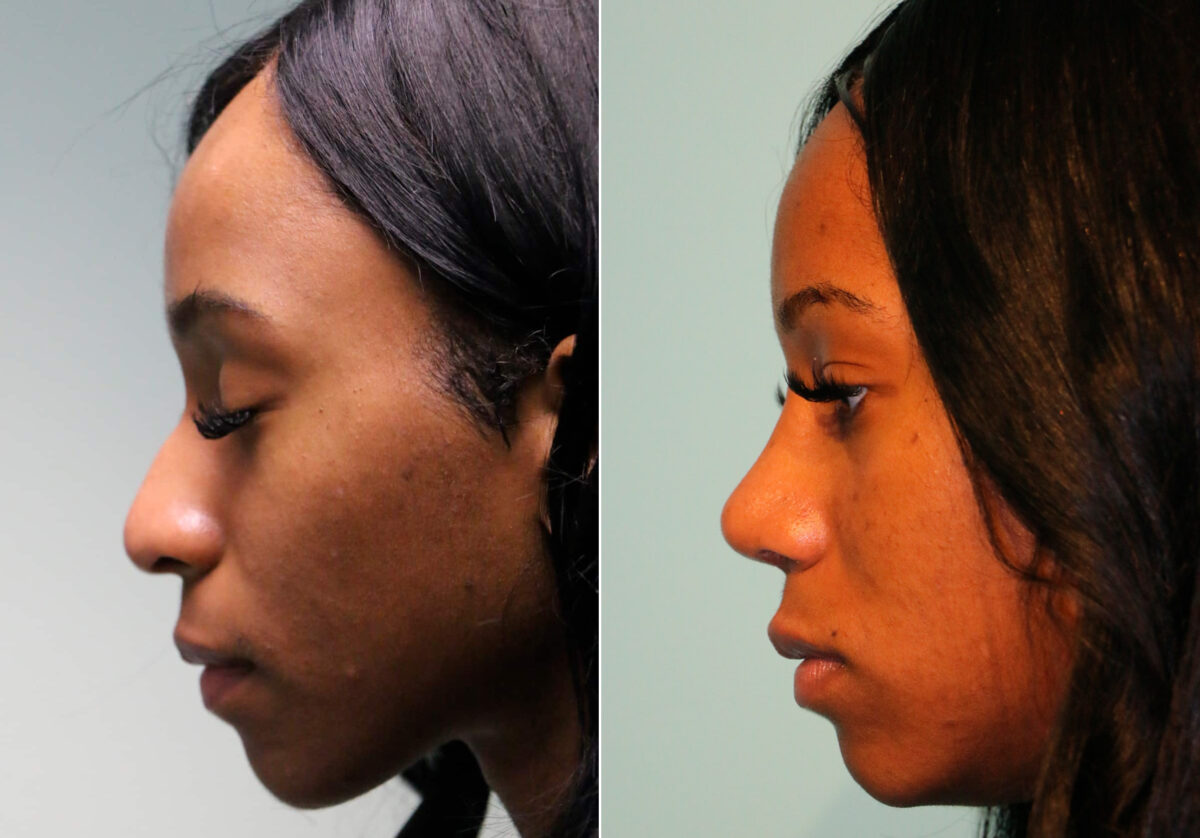 Before and after Rhinoplasty by Dr. Shervin Naderi, Patient 13410