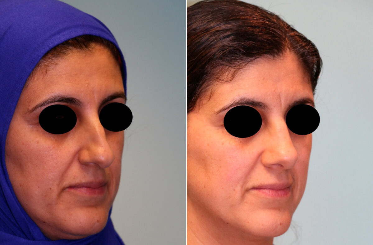 Before and after Rhinoplasty by Dr. Shervin Naderi, Patient 13424