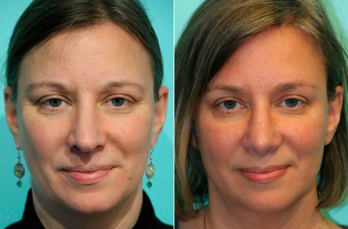 Before and after Rhinoplasty by Dr. Shervin Naderi, Patient 13436