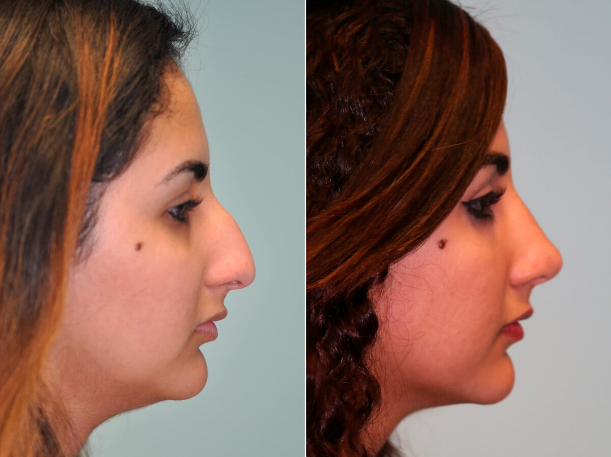 Before and after Rhinoplasty by Dr. Shervin Naderi, Patient 13725