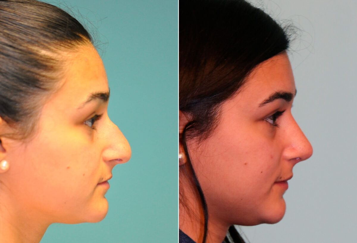 Before and after Rhinoplasty by Dr. Shervin Naderi, Patient 13780