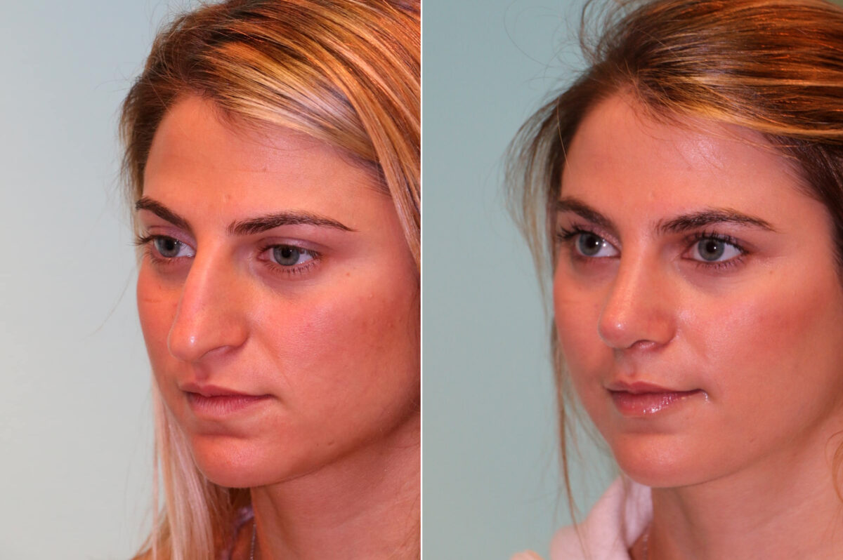 Before and after Rhinoplasty by Dr. Shervin Naderi, Patient 14015