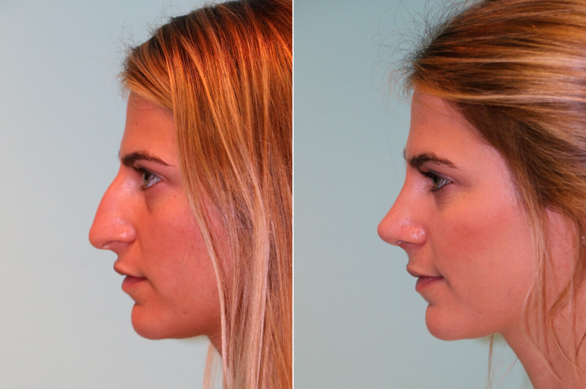 Before and after Rhinoplasty by Dr. Shervin Naderi, Patient 14015