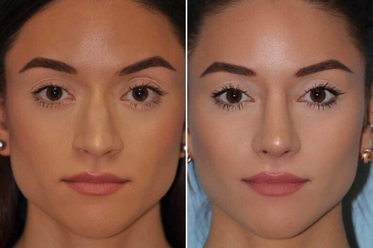 Before and after rhinoplasty by Dr. Shervin Naderi, front view