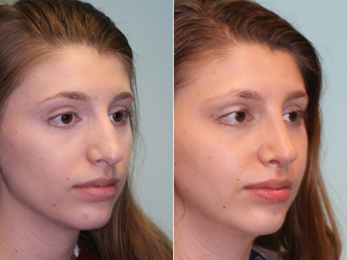 Before and after Rhinoplasty by Dr. Shervin Naderi, Patient 14295