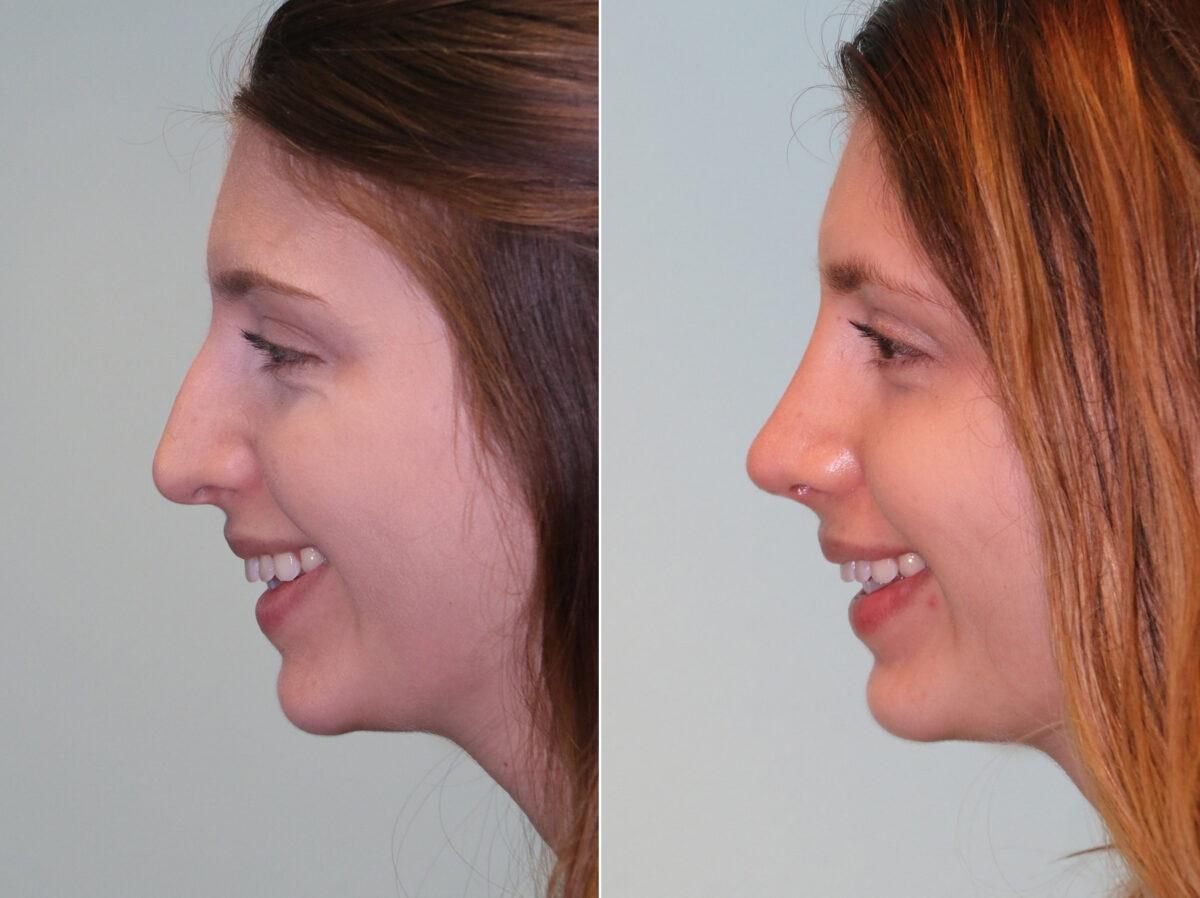 Before and after Rhinoplasty by Dr. Shervin Naderi, Patient 14295