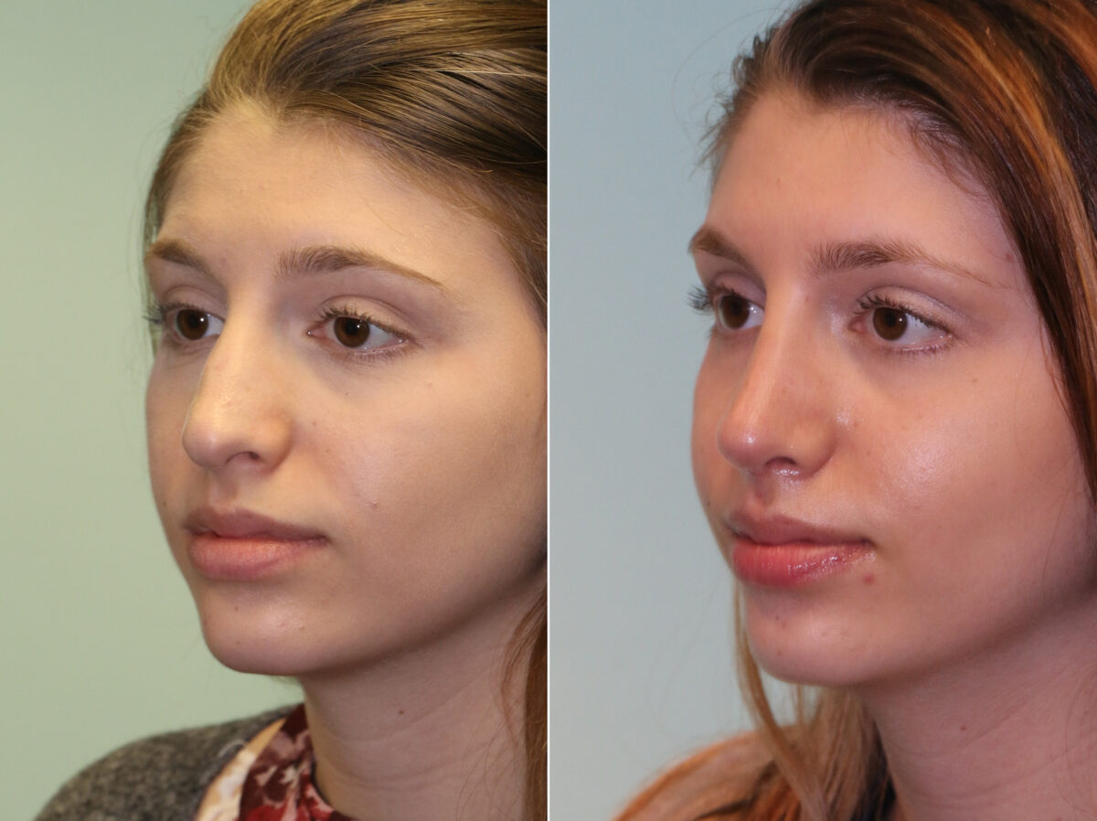 Before and after Rhinoplasty by Dr. Shervin Naderi, Patient 14295